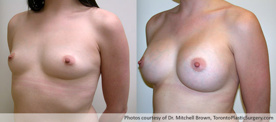 354gm Textured Round Gel Implant, Subpectoral Fold Incision, Before and After 6 Months