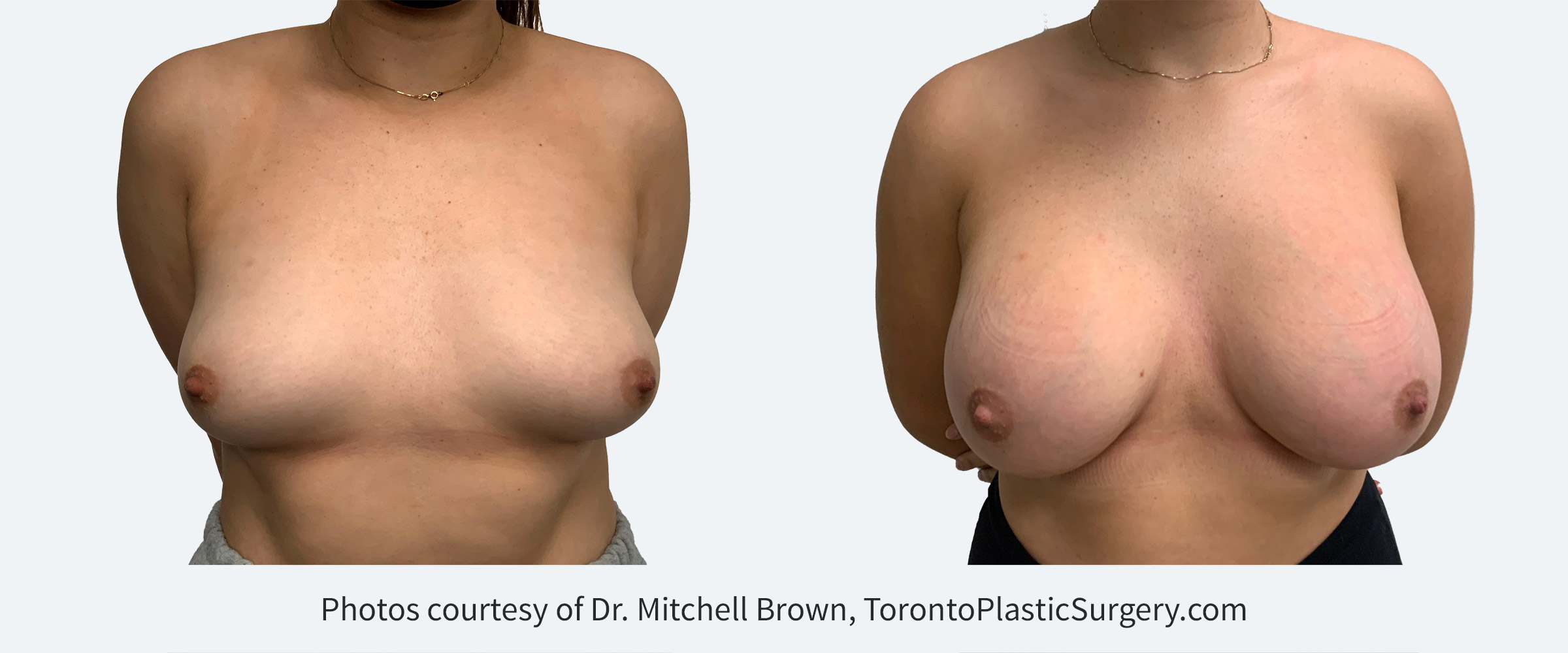 Narrowing a wide gap with moderate projection 445cc implants, Before and After 6 Months