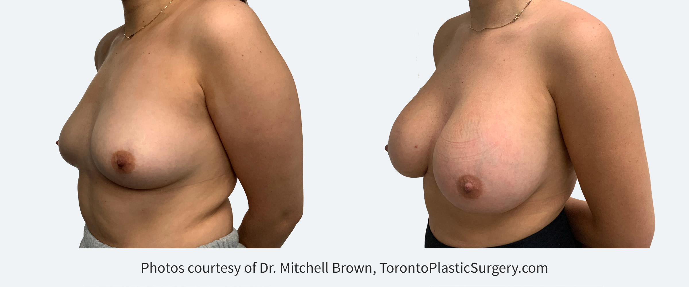 Narrowing a wide gap with moderate projection 445cc implants, Before and After 6 Months