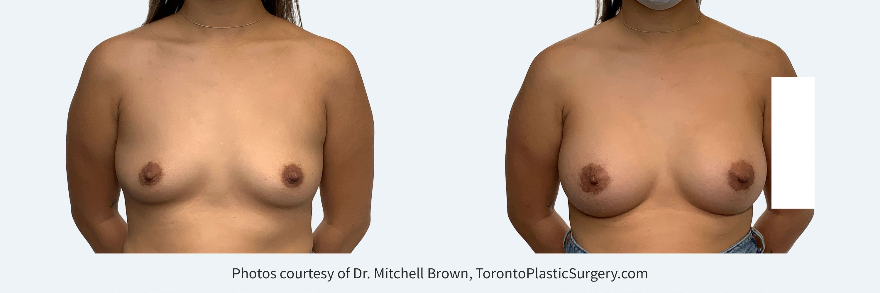 405gm round gel implants under the muscle, Before and After 6 months