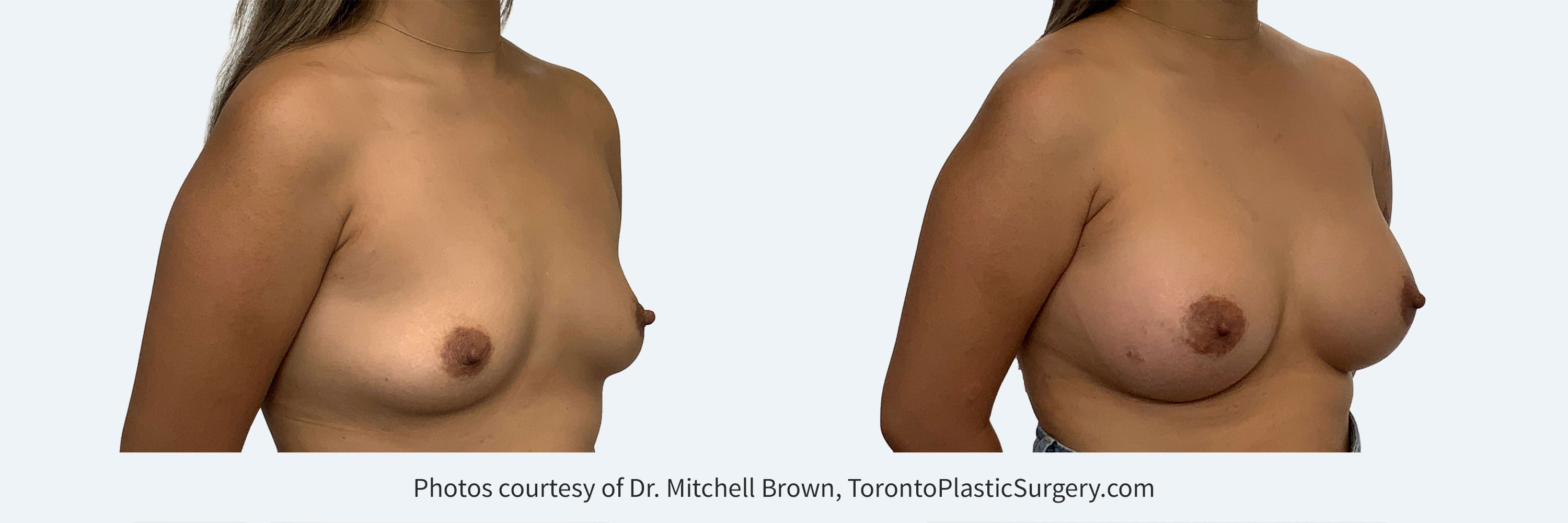 405gm round gel implants under the muscle, Before and After 6 months