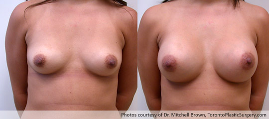 290gm Textured Round Gel Implant, Subpectoral Fold Incision, Before and After 6 Months