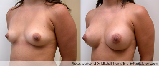 290gm Textured Round Gel Implant, Subpectoral Fold Incision, Before and After 6 Months