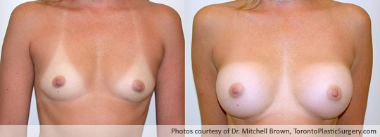 300gm Smooth Round Gel Implant, Subpectoral Fold Incision, Before and After 6 Months