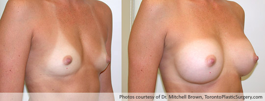 300gm Smooth Round Gel Implant, Subpectoral Fold Incision, Before and After 6 Months