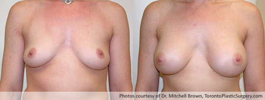 285gm Smooth Round Gel Implant, Subpectoral Fold Incision, Before and After 6 Months