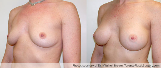 285gm Smooth Round Gel Implant, Subpectoral Fold Incision, Before and After 6 Months