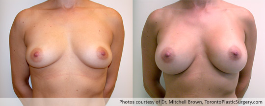 300gm Round Gel Implant, Subpectoral Fold Incision, Before and After 6 Months