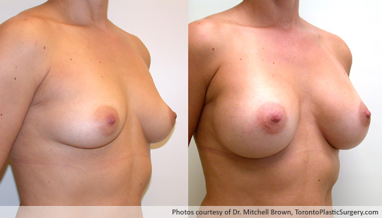 300gm Round Gel Implant, Subpectoral Fold Incision, Before and After 6 Months