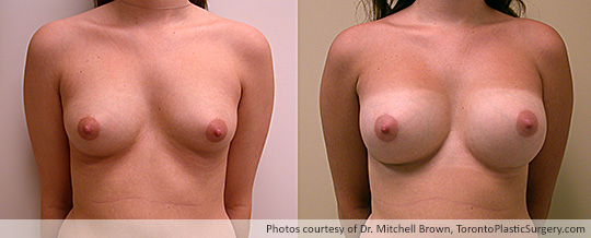 Breast Asymmetry and Round Gel Implants:  Subpectoral Fold Incision, 300cc Left, 270cc Right, Before and After 18 Months
