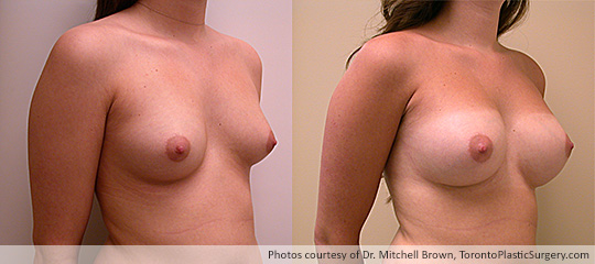 Breast Asymmetry and Round Gel Implants: Subpectoral Fold Incision, 300cc Left, 270cc Right, Before and After 18 Months