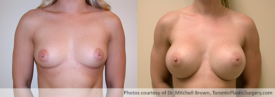 435gm Round Gel Implants, Subpectoral, Fold Incision, Before and After 8 Months