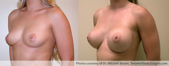 435gm Round Gel Implants, Subpectoral, Fold Incision, Before and After 8 Months