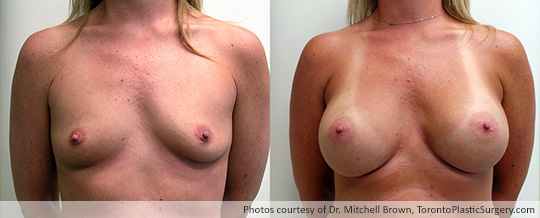 500gm Round Gel Implants, Subpectoral, Fold Incision, Before and After 6 Months