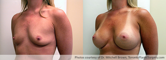 500gm Round Gel Implants, Subpectoral, Fold Incision, Before and After 6 Months