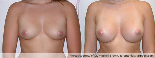 360cc Left / 340cc Right Saline Implants, Subglandular Augmentation Fold Incision, Before and After 6 Months