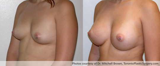 360cc Left / 340cc Right Saline Implants, Subglandular Augmentation Fold Incision, Before and After 6 Months