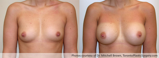 390cc Saline Implant, Subpectoral Fold Incision, Before and After 6 Months