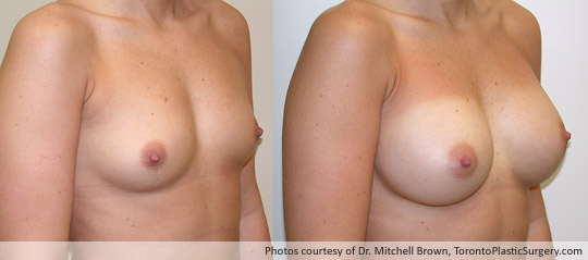 390cc Saline Implant, Subpectoral Fold Incision, Before and After 6 Months