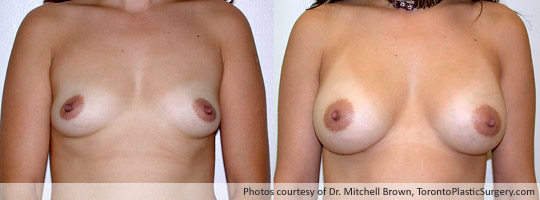 330cc Saline Implant, Subpectoral Fold Incision, Before and After 6 Months