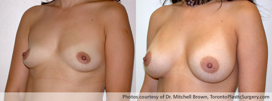 330cc Saline Implant, Subpectoral Fold Incision, Before and After 6 Months