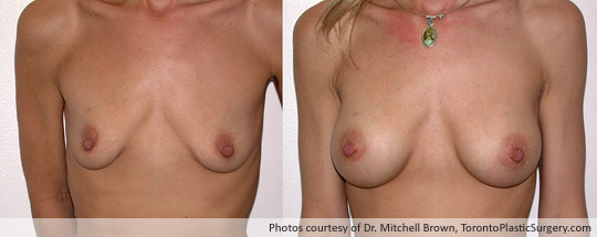 290cc Saline Implant (Emptiness following pregnancy), Subpectoral Fold Incision, Before and After 6 Months