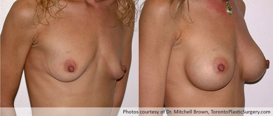 290cc Saline Implant (Emptiness following pregnancy), Subpectoral Fold Incision, Before and After 6 Months