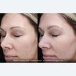 BBL/IPL Photofacial: Get Your Skin Ready for the Holidays — and Beyond