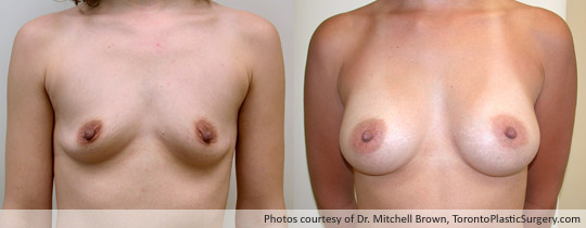 295gm Shaped Gel Implant, Subpectoral, Fold Incision, Before and After 8 Months