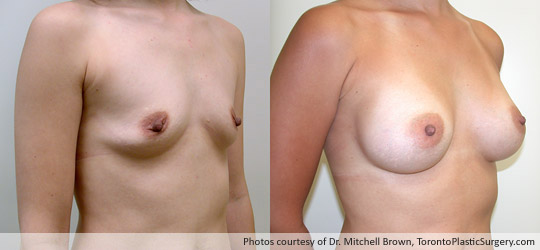 295gm Shaped Gel Implant, Subpectoral, Fold Incision, Before and After 8 Months