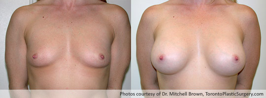 295gm Shaped Gel Implant, Subpectoral, Fold Incision, Before and After 1 Year