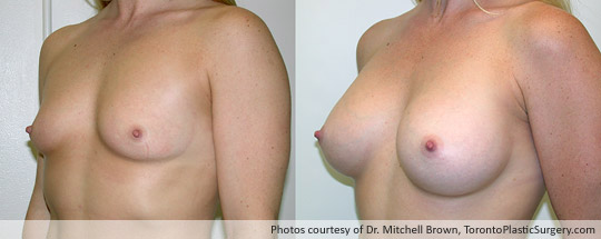 295gm Shaped Gel Implant, Subpectoral, Fold Incision, Before and After 1 Year