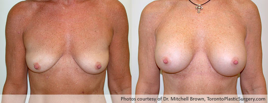 360gm Shaped Gel Implant, Subpectoral, Fold Incision, Before and After 1 Year