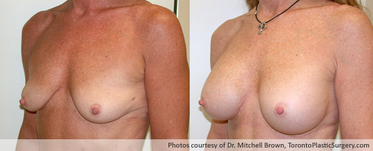 360gm Shaped Gel Implant, Subpectoral, Fold Incision, Before and After 1 Year