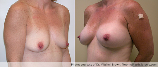 Shaped Gel Implants, Subpectoral, Fold Incision: Medium height, Full Projection – 295 gms, Before and After 8 Years