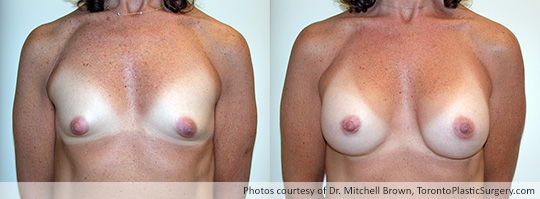 Tuberous Breast Surgery with Insertion of Shaped Gel Implants, 225gm, Under Muscle, Fold Incision, Before and After 6 Months