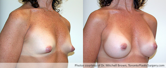 Shaped Gel Implants, 225gm, Under Muscle, Fold Incision, Before and After 6 Months