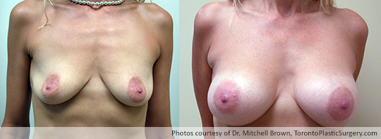 Shaped Gel Implants, 295gm, Under Muscle, Fold Incision, Before and After 7 Years