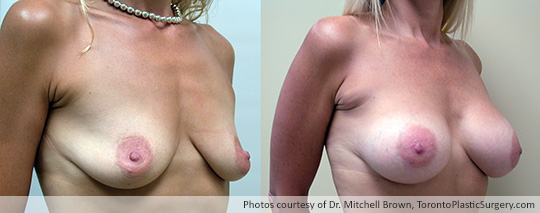 Shaped Gel Implants, 295gm, Under Muscle, Fold Incision, Before and After 7 Years