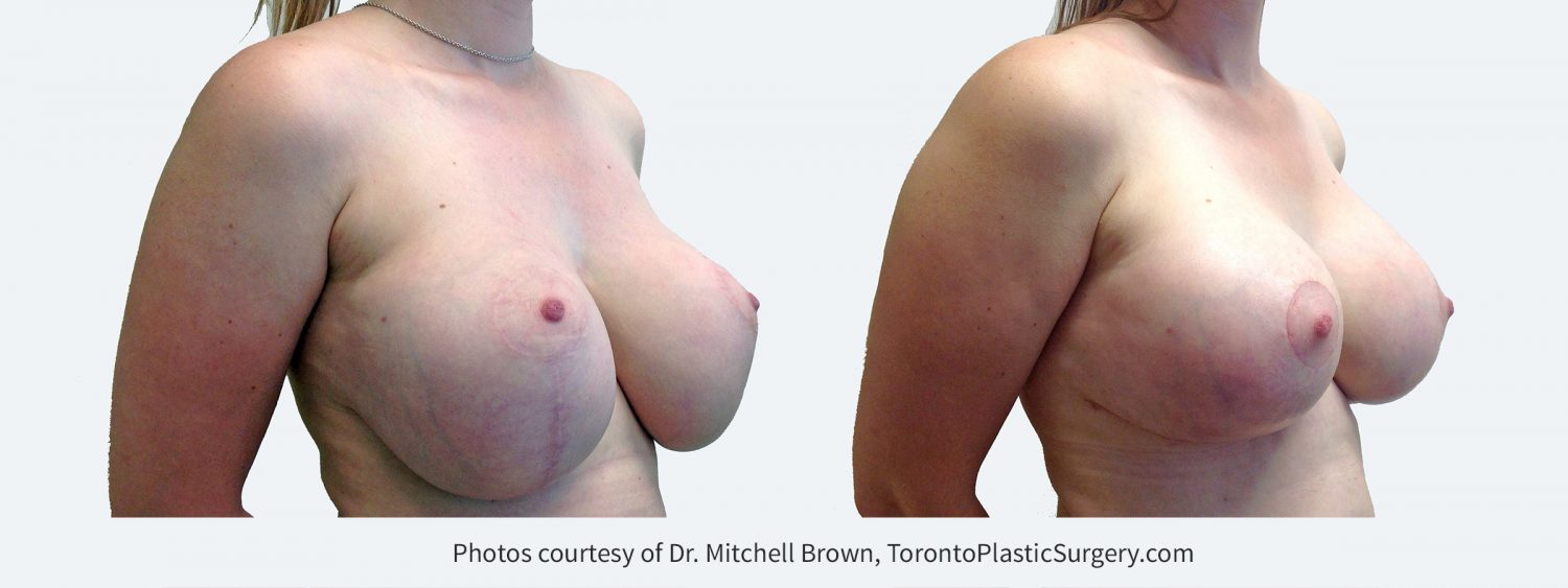 Large implants with inadequate breast lift. This has resulted in stretching of the breast skin and nipples placed too high. Correction with small downsizing of implants and revision of the breast lift including internal support for the implant position. Before and 4 months after