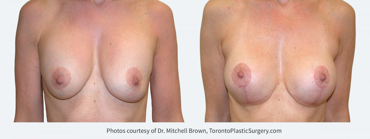 Previous breast augmentation under the muscle with a breast lift. Implants have remained soft, however there has been sagging of the breast tissue. Correction performed with replacement of silicone gel implants in a new position under the muscle and revision of the breast lift with removal of lower breast tissue. Before and 3 months after. 