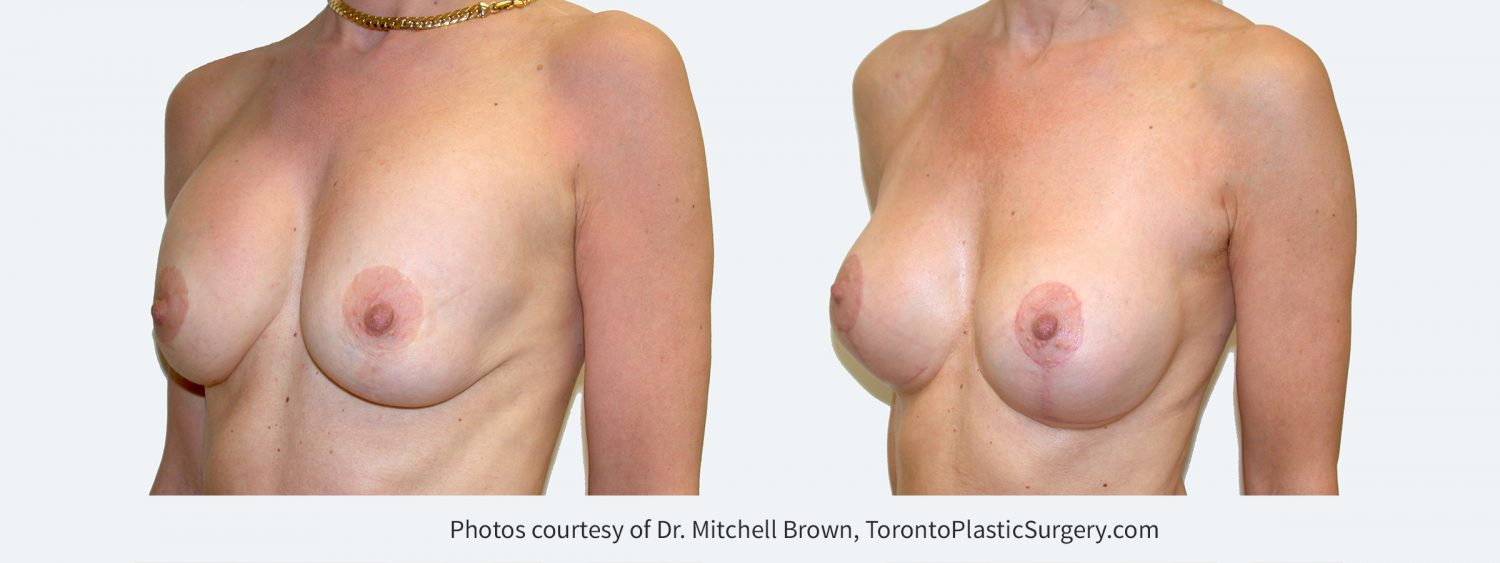 Previous breast augmentation under the muscle with a breast lift. Implants have remained soft, however there has been sagging of the breast tissue. Correction performed with replacement of silicone gel implants in a new position under the muscle and revision of the breast lift with removal of lower breast tissue. Before and 3 months after. 
