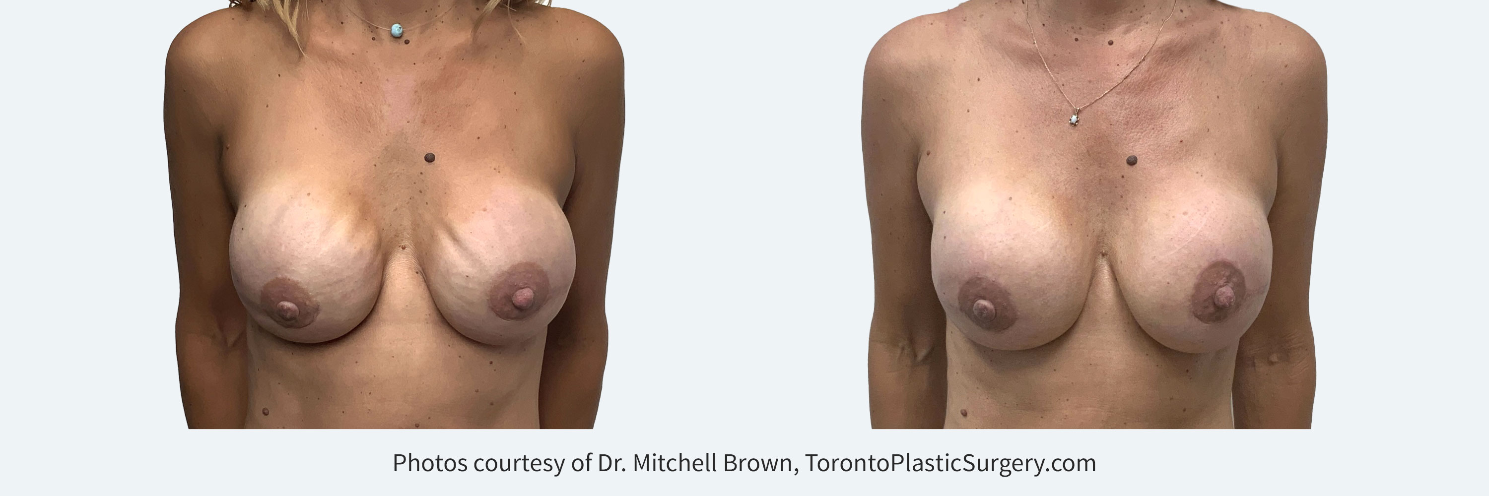 Nipple sparing mastectomy reconstructed using breast implants with severe visible rippling. Corrected with a combination of more highly cohesive implants, fat grafting and insertion of an internal sling for implant support. Before and 6 months after.