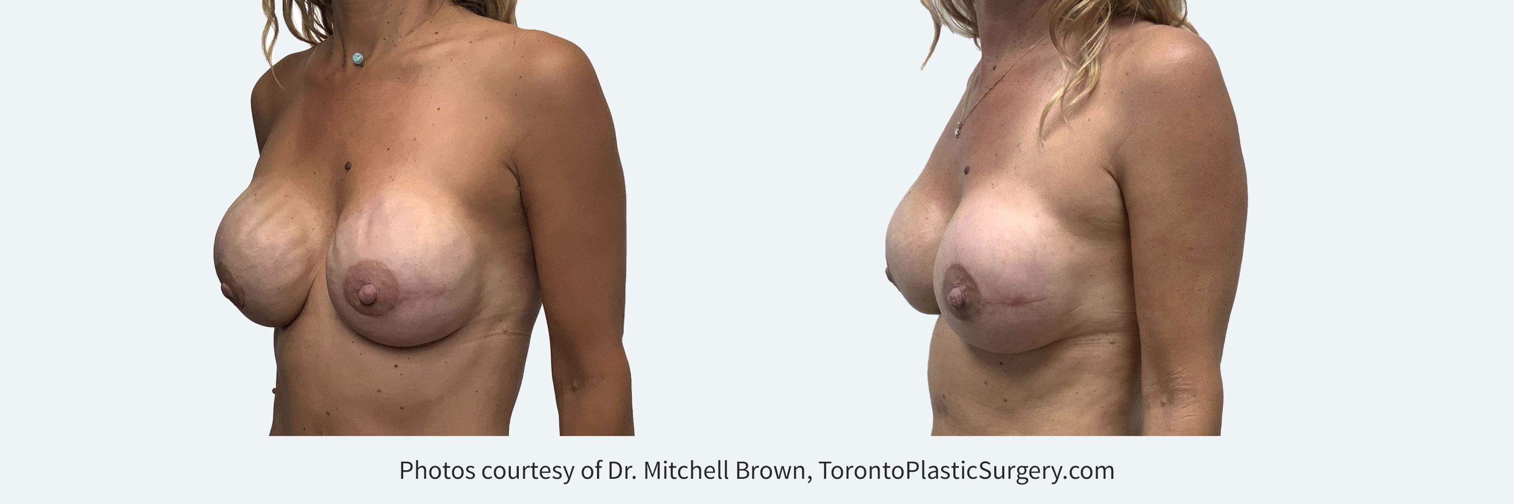 Nipple sparing mastectomy reconstructed using breast implants with severe visible rippling. Corrected with a combination of more highly cohesive implants, fat grafting and insertion of an internal sling for implant support. Before and 6 months after.