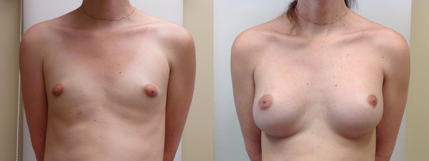 Trans-female breast augmentation with 420 cc implants, fold incision, Before and 3 Years