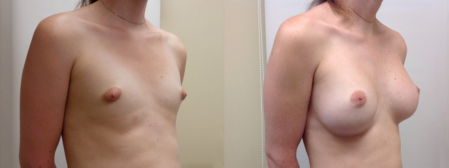 Trans-female breast augmentation with 420 cc implants, fold incision, Before and 3 Years