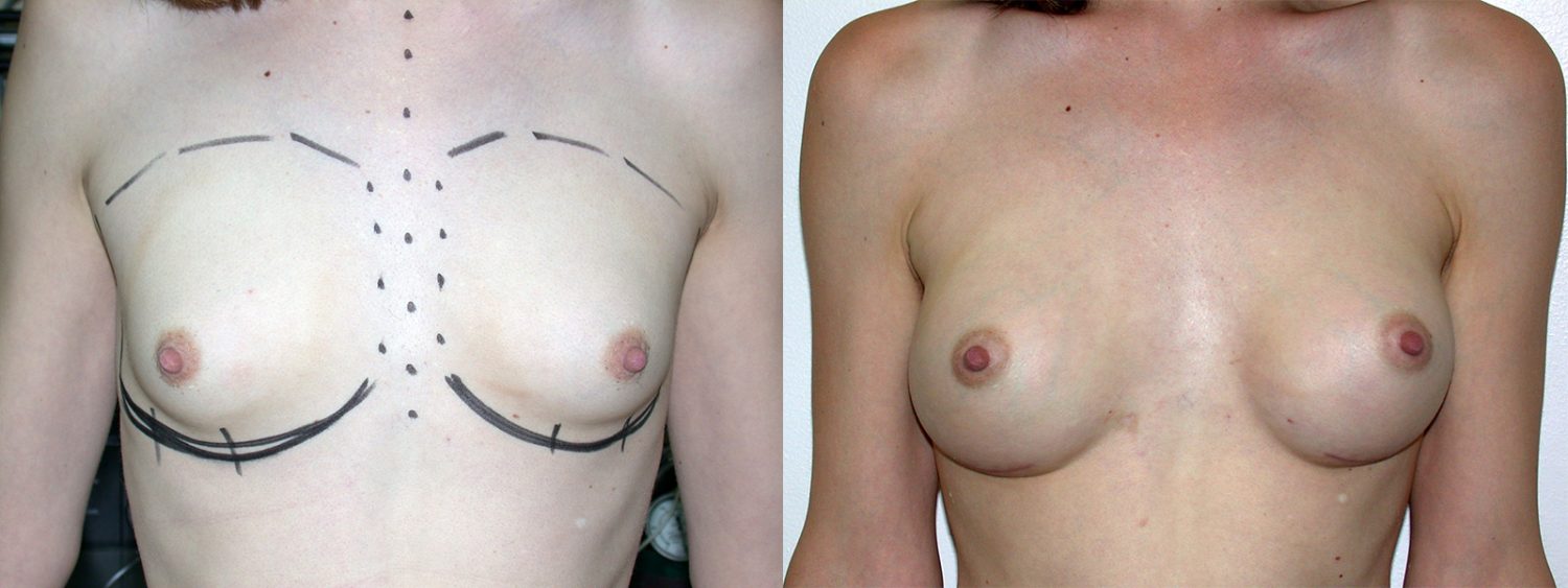 Trans-female breast augmentation, 280cc implant, fold incision, Before and 4 Years