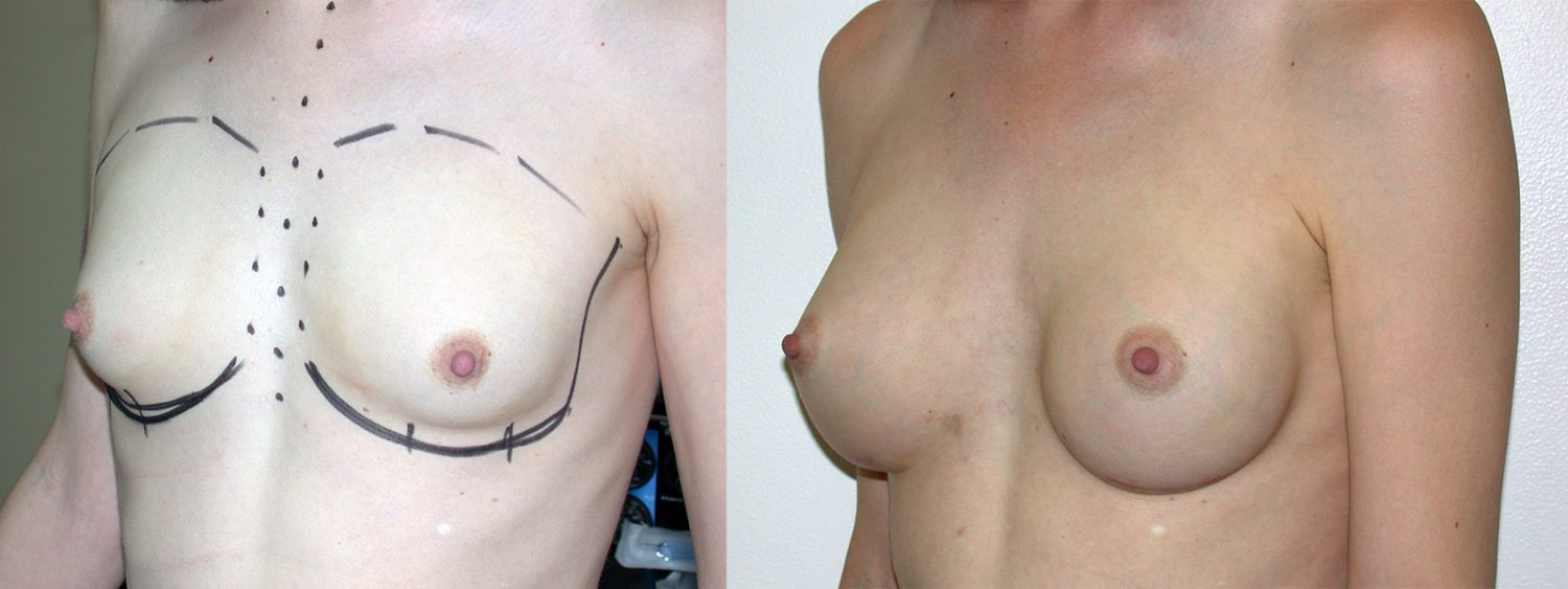 Trans-female breast augmentation, 280cc implant, fold incision, Before and 4 Years