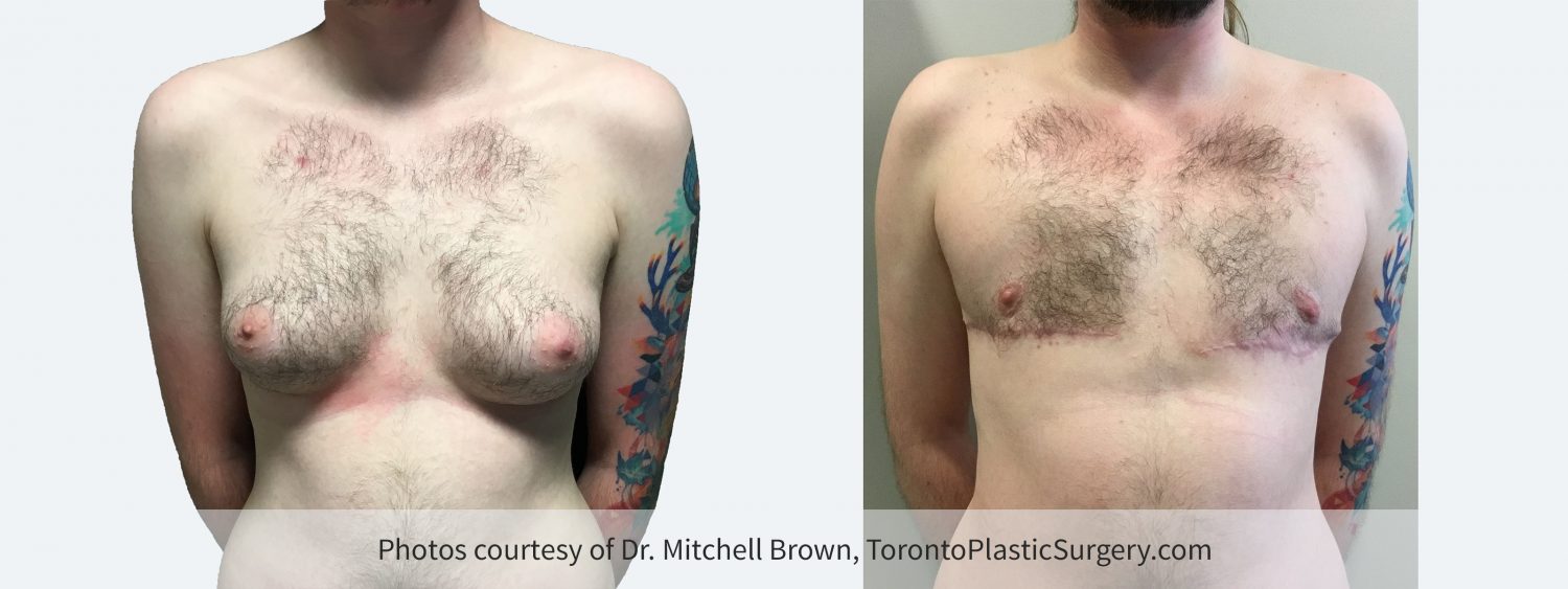Transmale, Double Incision-Free Nipple Graft, Before and 3 Months After