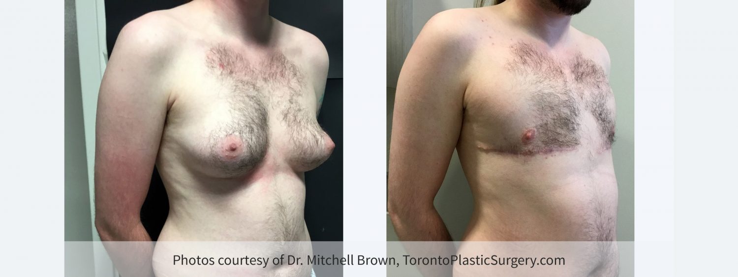 Transmale, Double Incision-Free Nipple Graft, Before and 3 Months After